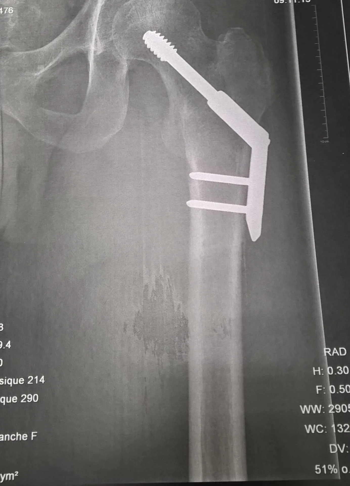 Fracture de la hanche